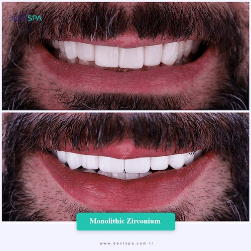 DENTSPA ISTANBUL ZIRCONIUM CROWNS 18