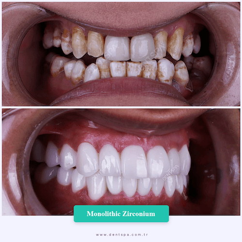 DENTSPA ISTANBUL ZIRCONIUM CROWNS 20