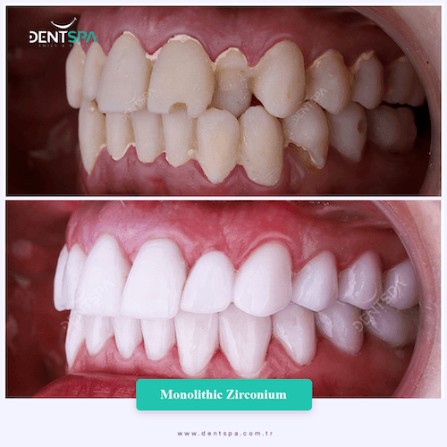 DENTSPA ISTANBUL ZIRCONIUM CROWNS 21