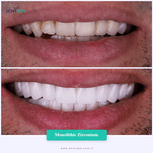 DENTSPA ISTANBUL ZIRCONIUM CROWNS 22