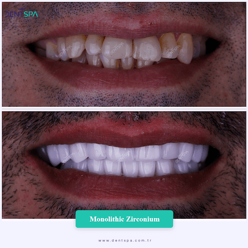 DENTSPA ISTANBUL ZIRCONIUM CROWNS 23