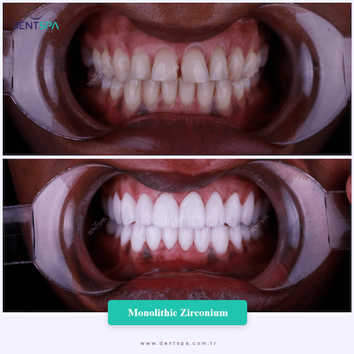 DENTSPA ISTANBUL ZIRCONIUM CROWNS 24