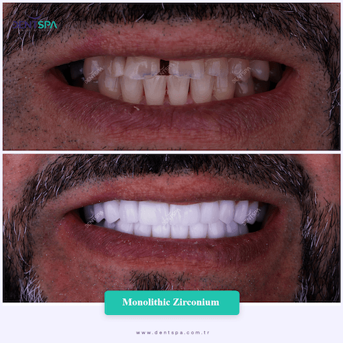 DENTSPA ISTANBUL ZIRCONIUM CROWNS 25