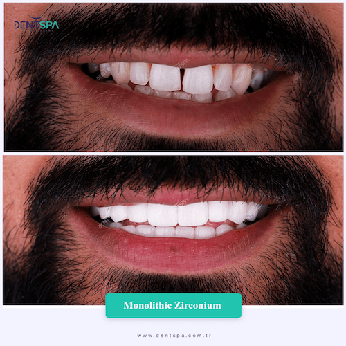 DENTSPA ISTANBUL ZIRCONIUM CROWNS 26