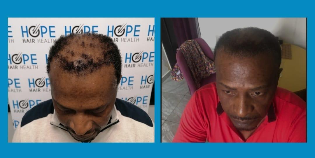 Afro FUE / Ethnic FUE result in Istanbul