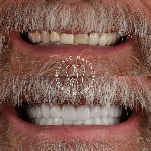 Da Vinci hollywood smiles3