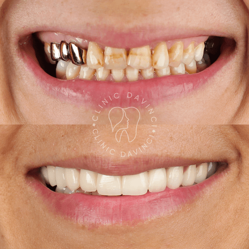 Da Vinci hollywood smiles6