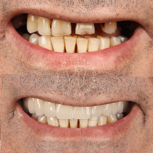 Da Vinci hollywood smiles5