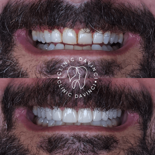 Da Vinci hollywood smiles7