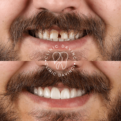 Da Vinci hollywood smiles8