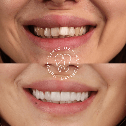 Da Vinci hollywood smiles9