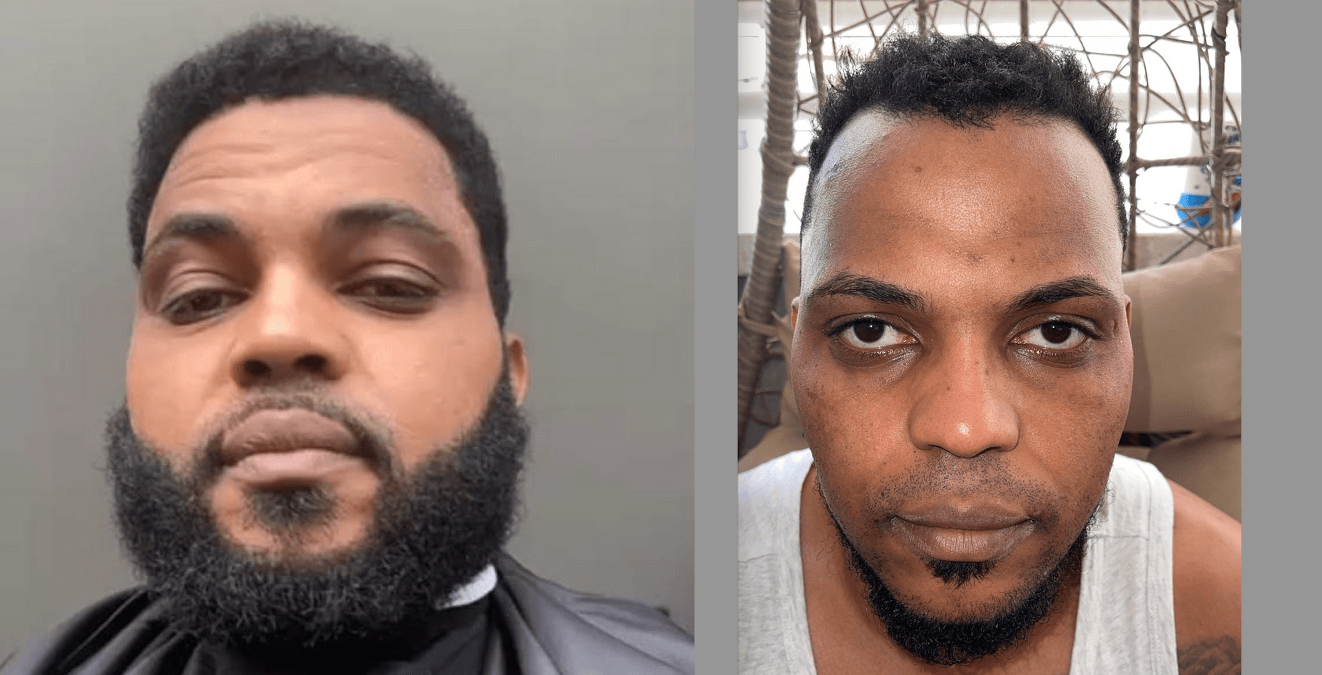 hope hair health - Afro hair transplant results