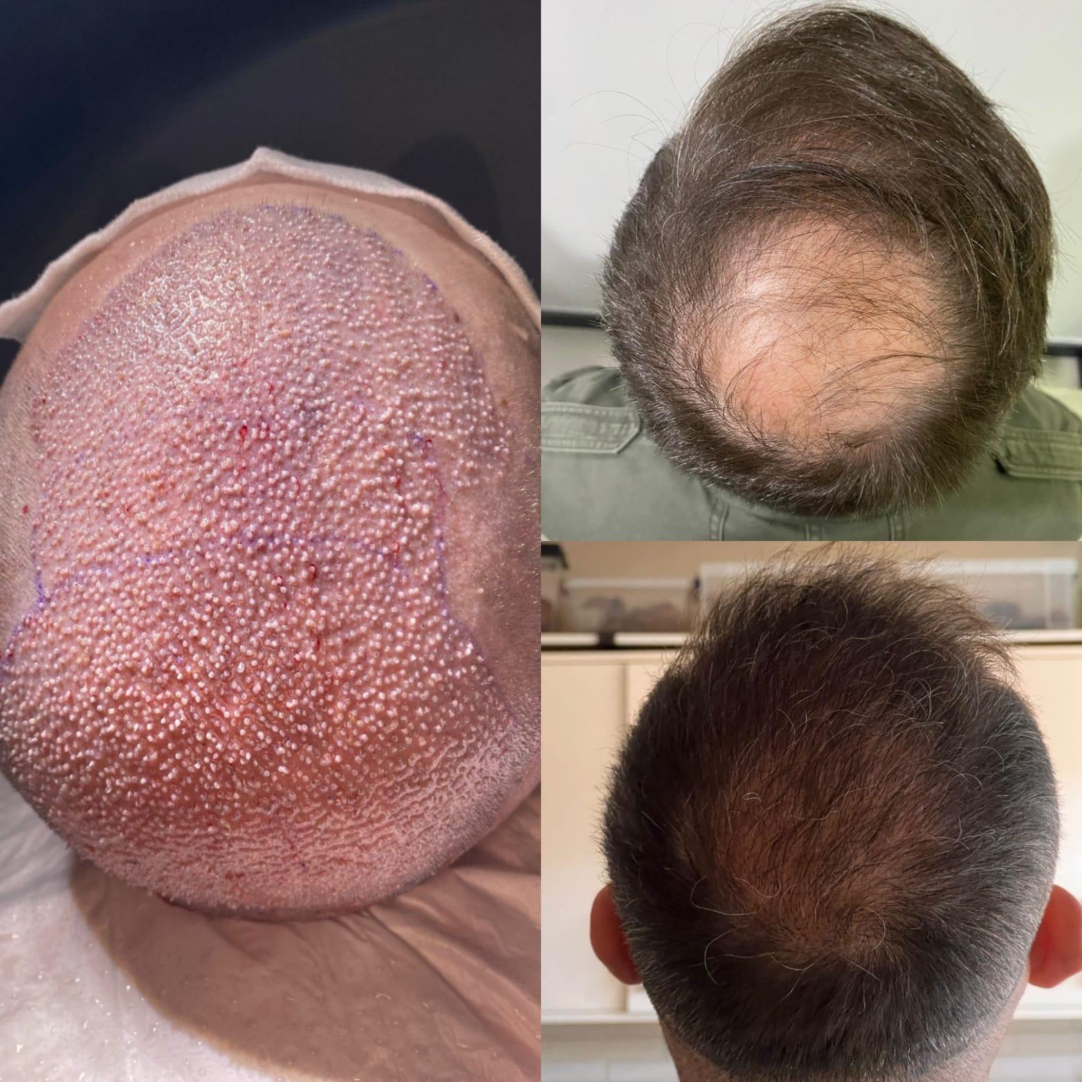 Hope Hair Health Resultats 1