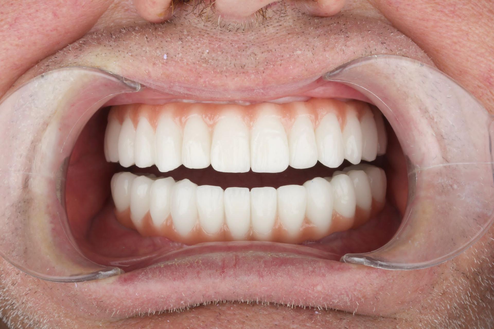 Dental reconstruction