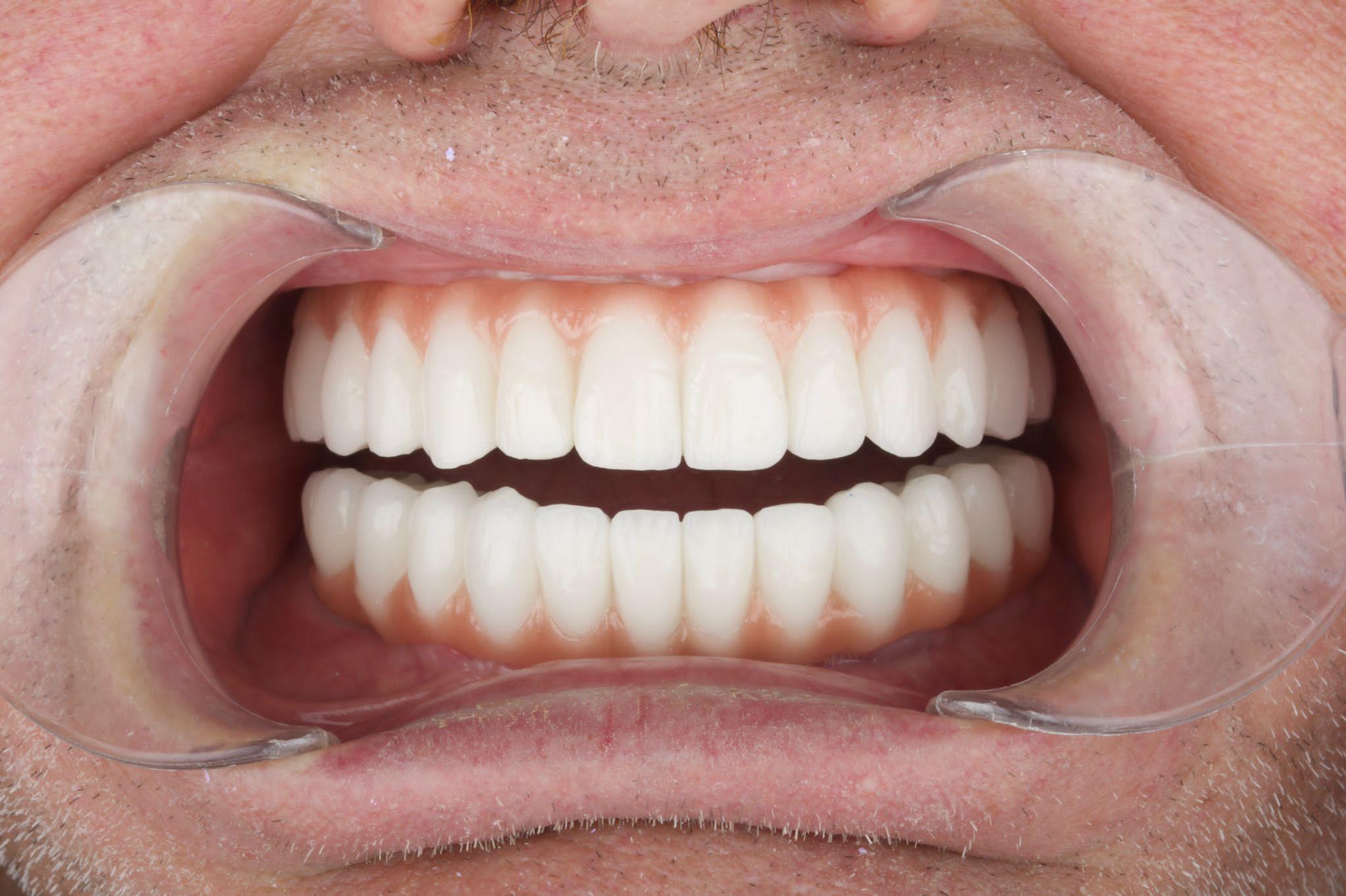 Dental reconstruction