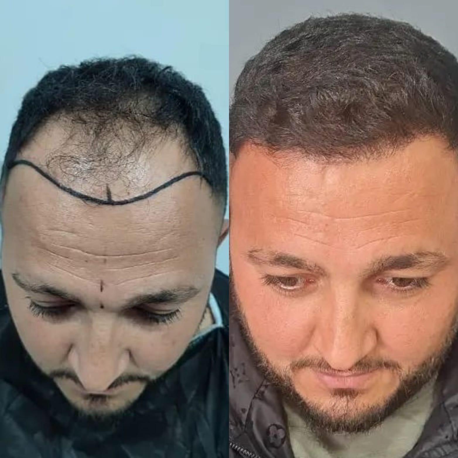 Hope Hair Health Resultats 2