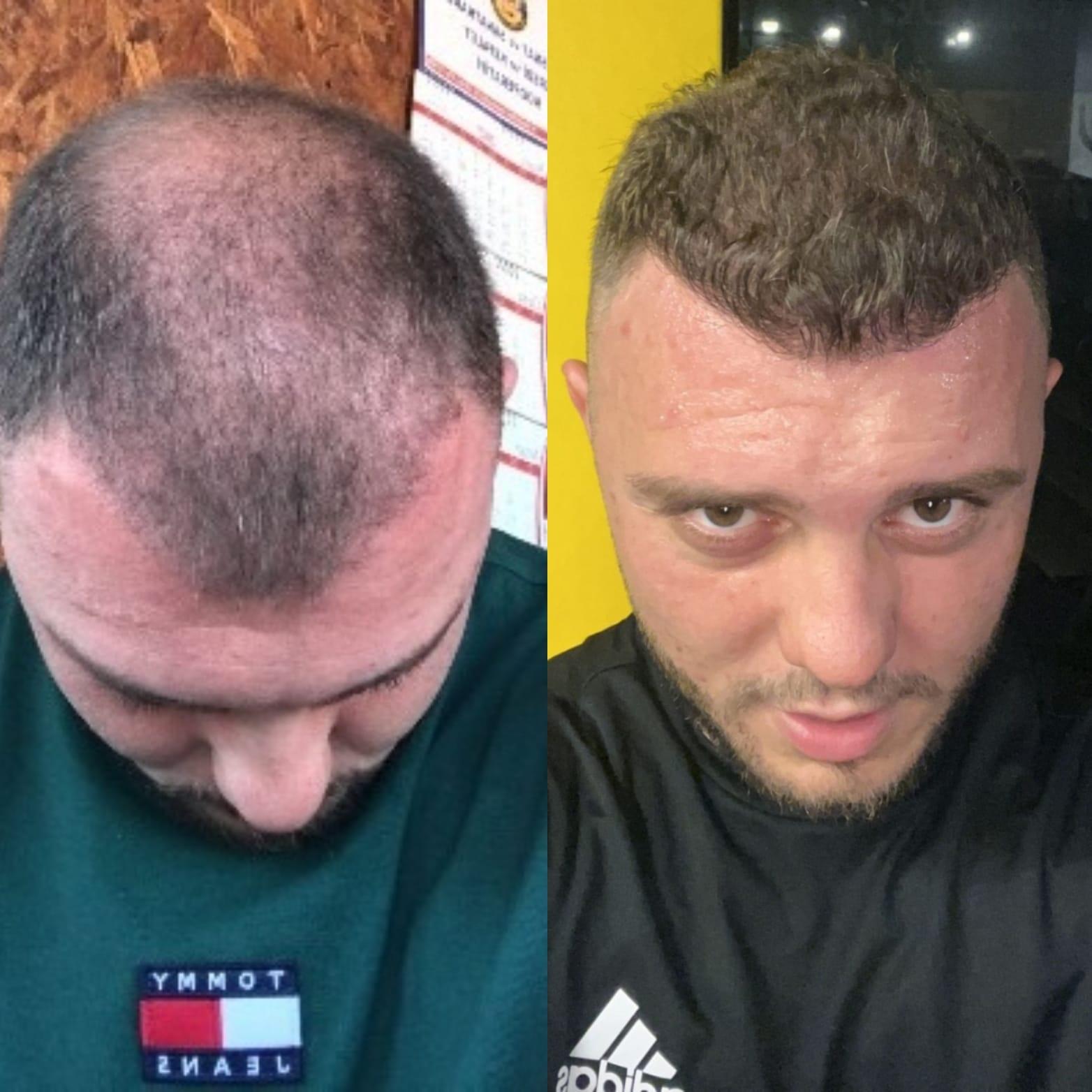 Hope Hair Health Resultats 3