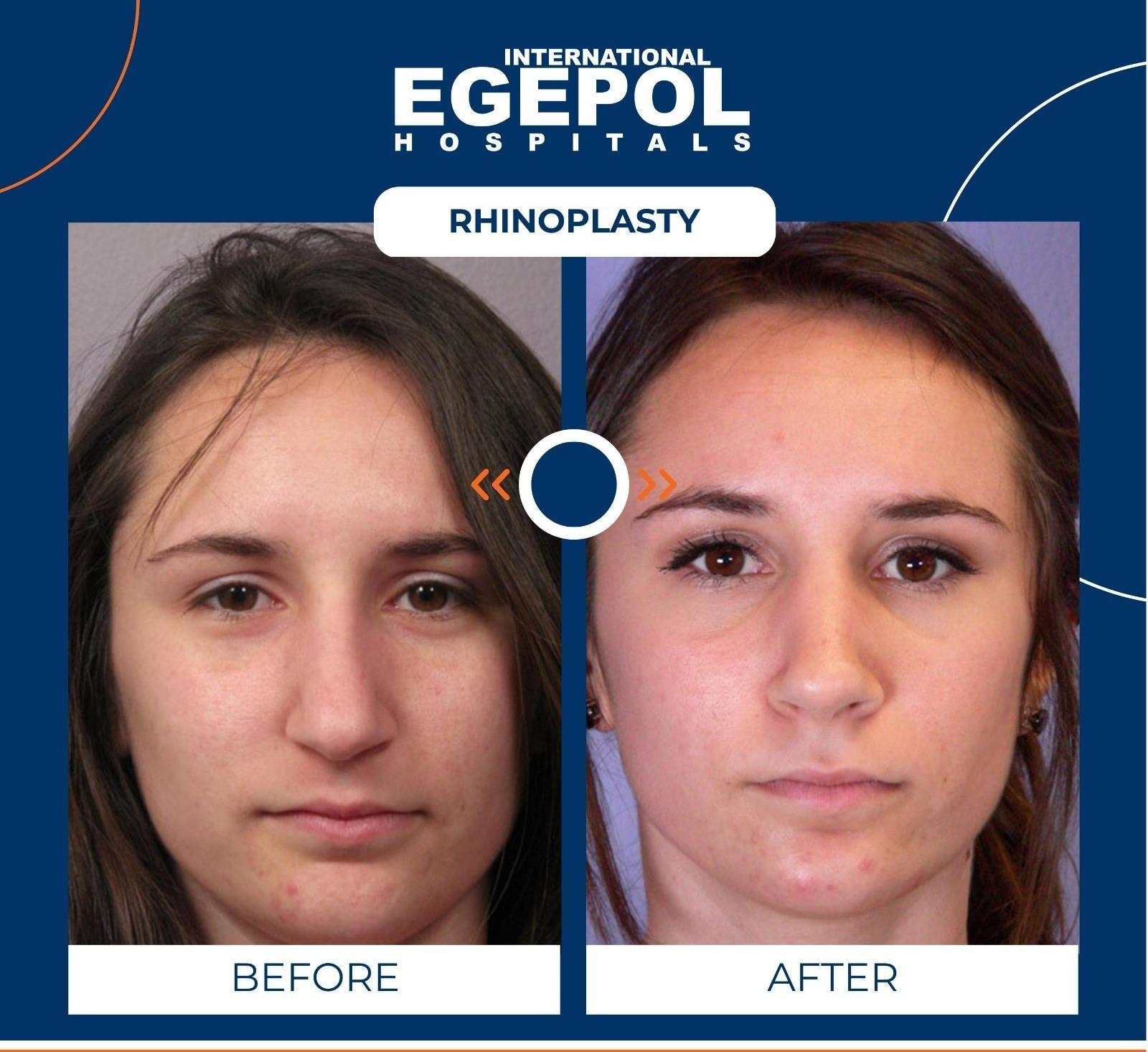 Rhinoplasty by Egepol  2