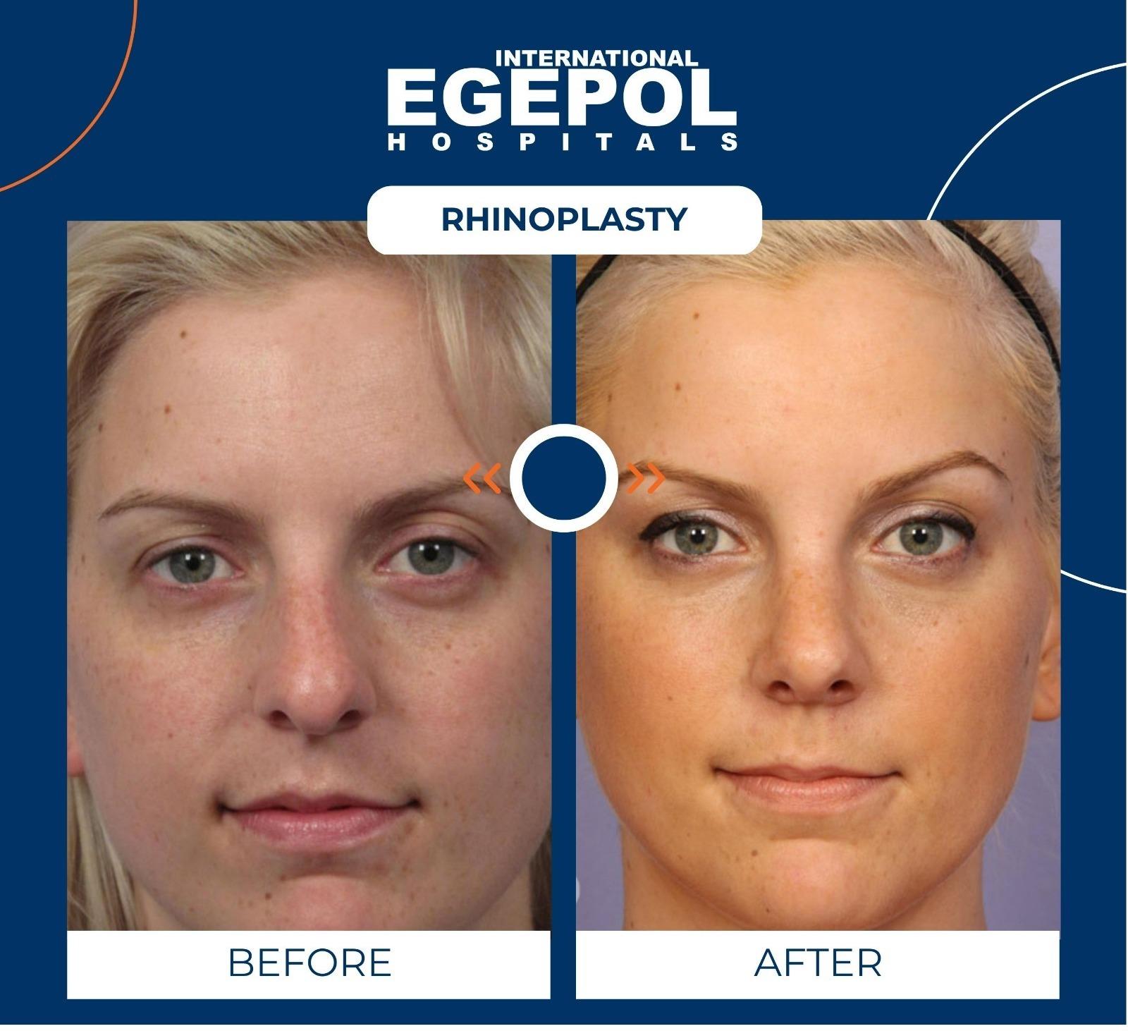 Rhinoplasty by Egepol  3