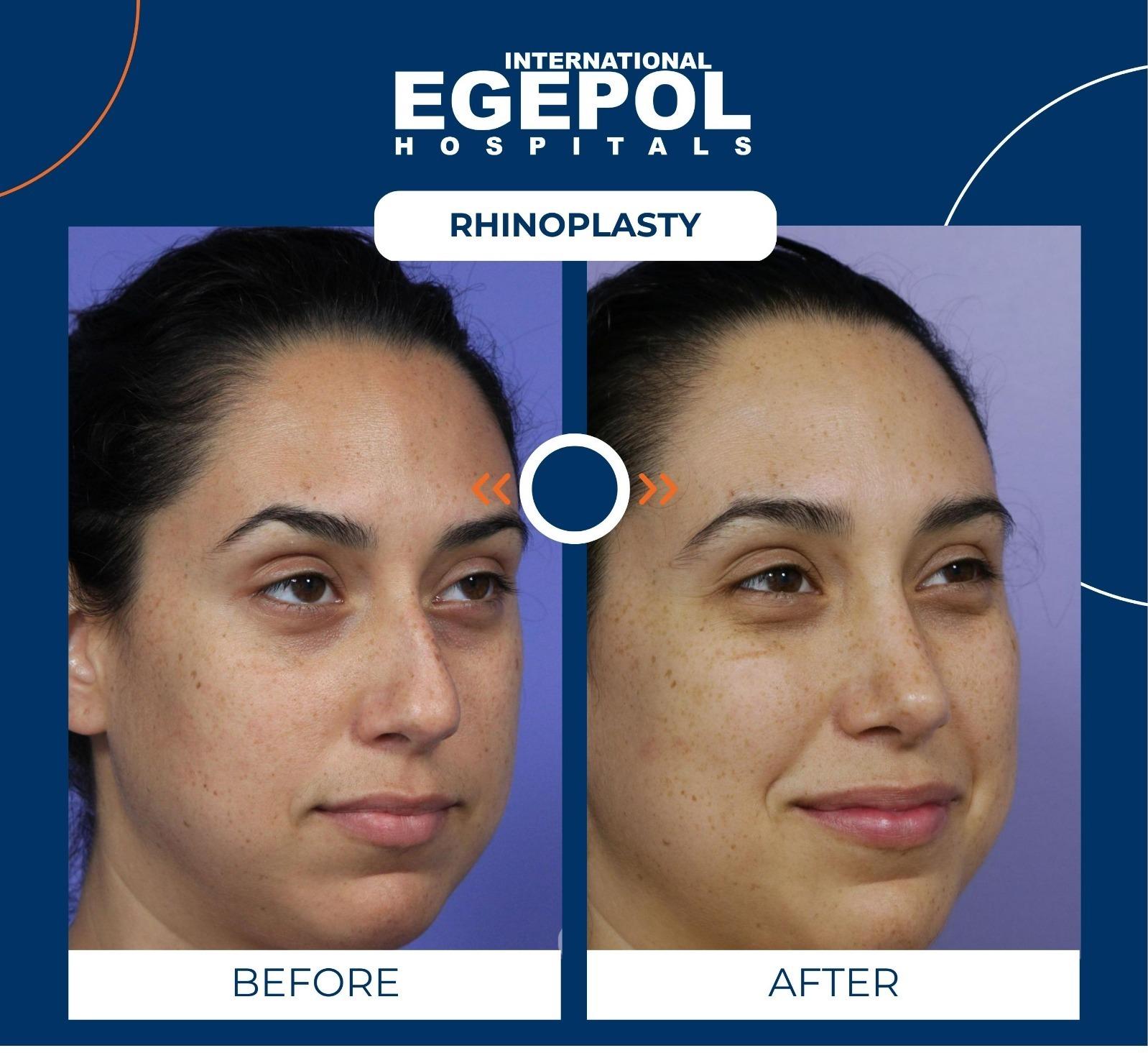 Rhinoplasty by Egepol  4