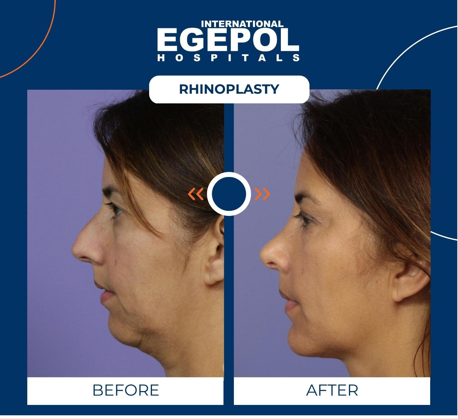 Rhinoplasty by Egepol  5