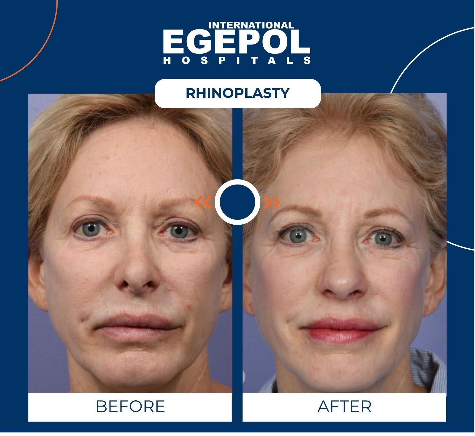 Rhinoplasty by Egepol  1