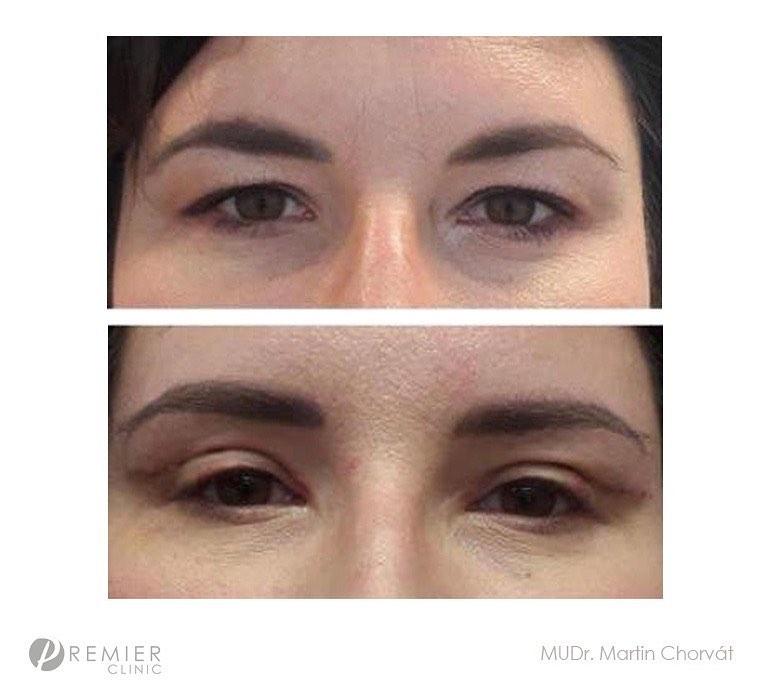 blepharoplasty by Premier Clinic