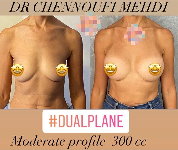Breast Augmentation Mehdi Chennoufi 4