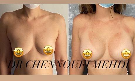 Breast Augmentation Mehdi Chennoufi 2