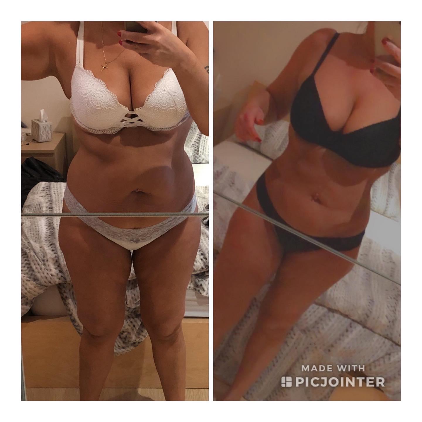 Liposuccion by Dr Chennoufi