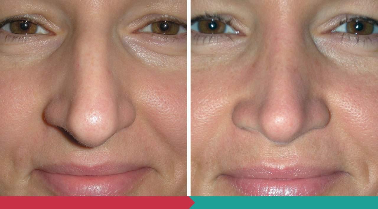 Rhinoplasty ABClinic Praha1