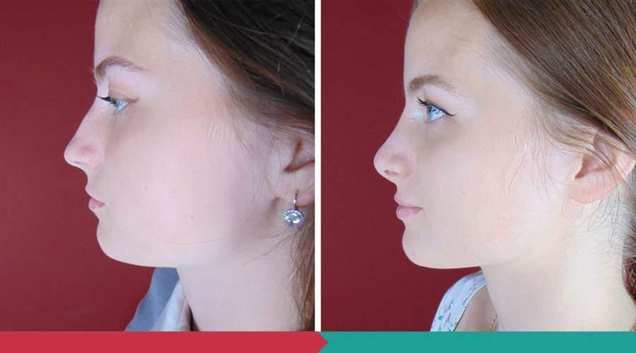 Rhinoplasty ABClinic Praha5