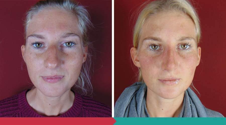 Rhinoplasty ABClinic Praha9