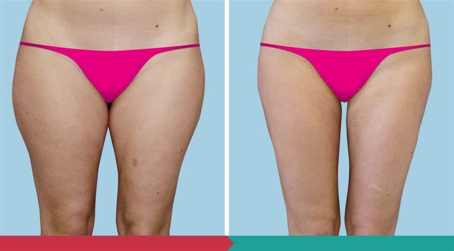 Liposuction ABClinic Praha1