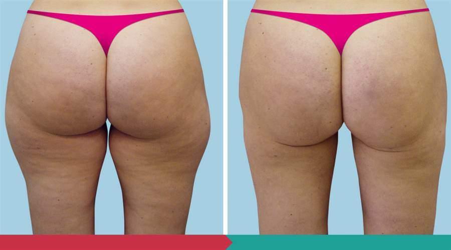 Liposuction ABClinic Praha2