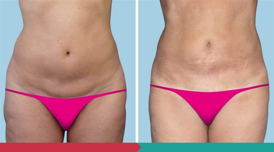 Liposuction ABClinic Praha3