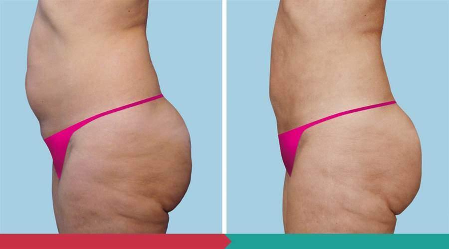 Liposuction ABClinic Praha4