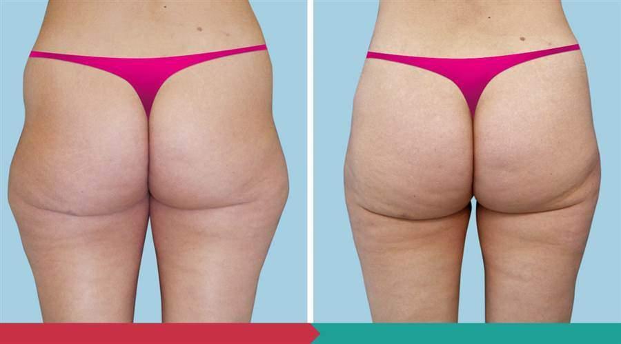 Liposuction ABClinic Praha5