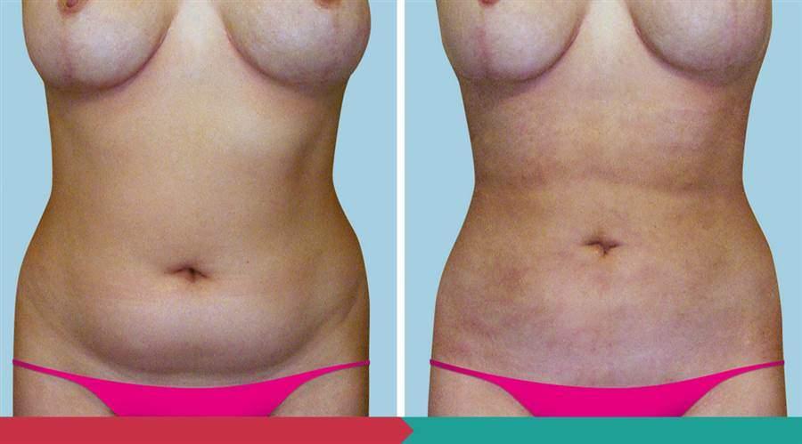 Liposuction ABClinic Praha6