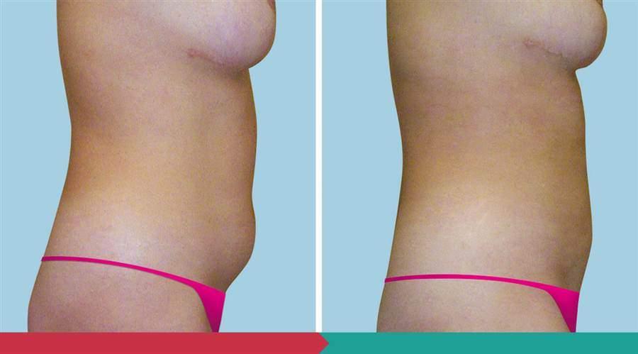 Liposuction ABClinic Praha7