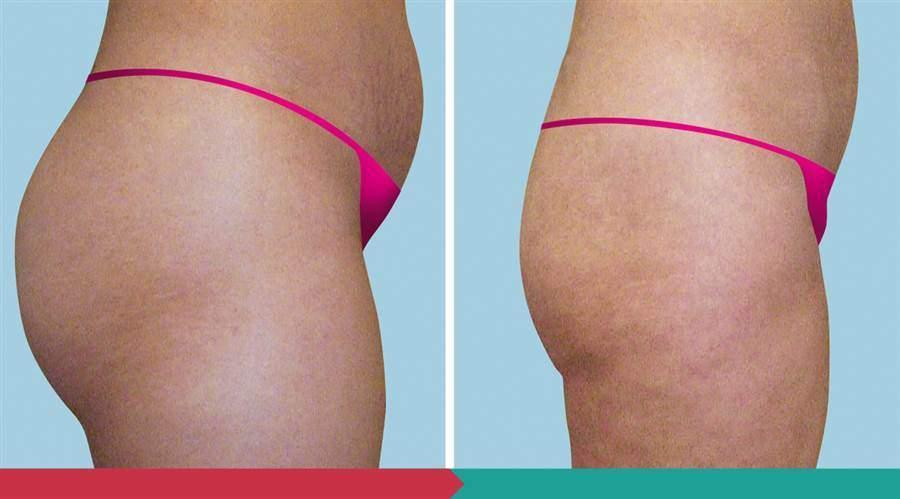 Liposuction ABClinic Praha8