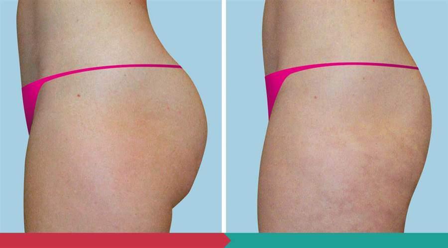 Liposuction ABClinic Praha9