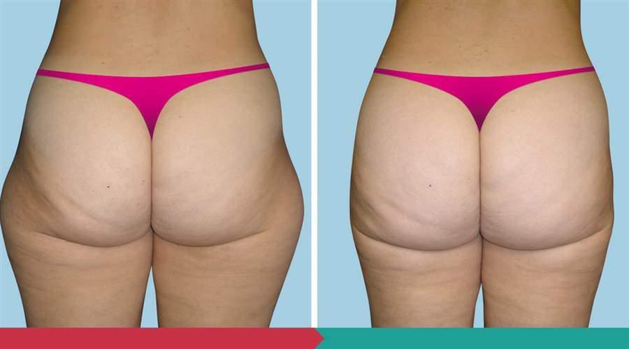 Liposuction ABClinic Praha10