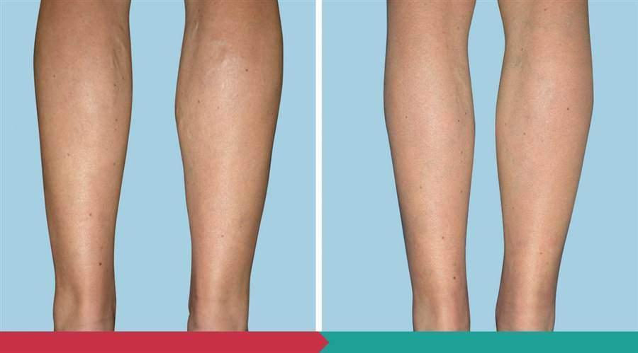 Liposuction ABClinic Praha11