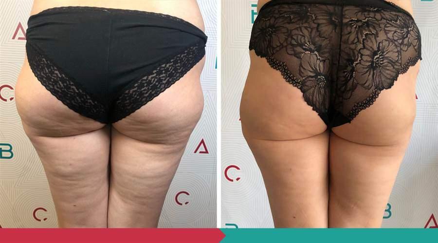 Liposuction ABClinic Praha12
