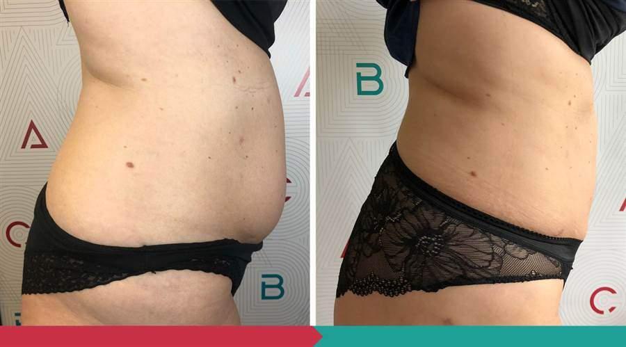 Liposuction ABClinic Praha13
