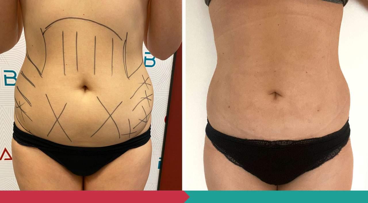 Liposuction ABClinic Praha14