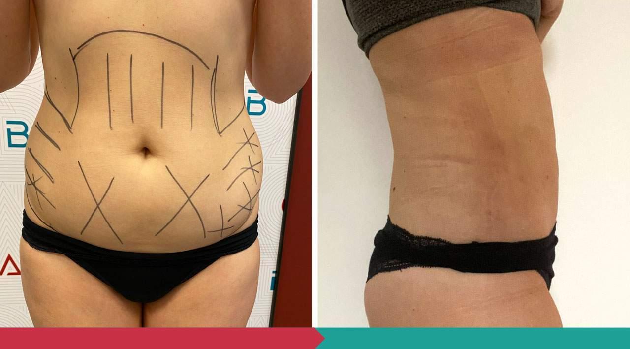 Liposuction ABClinic Praha15