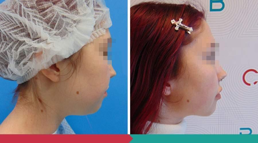 Liposuction ABClinic Praha16