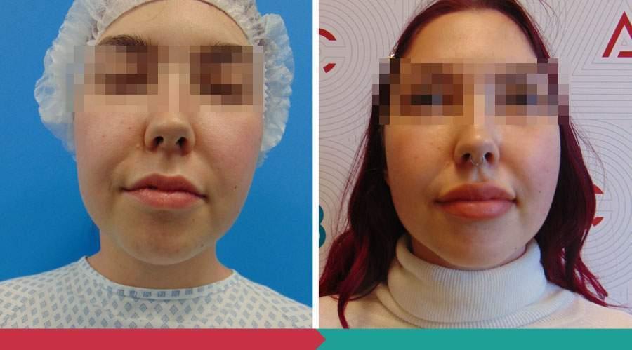 Liposuction ABClinic Praha17